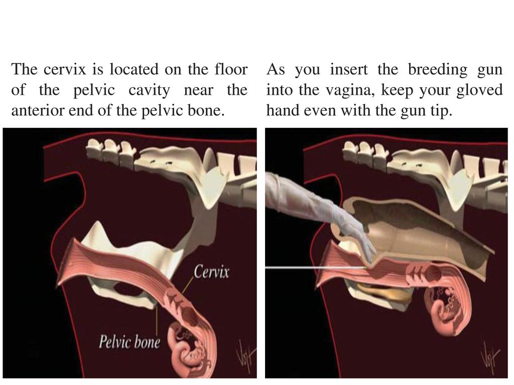 insertion gun vaginal hand